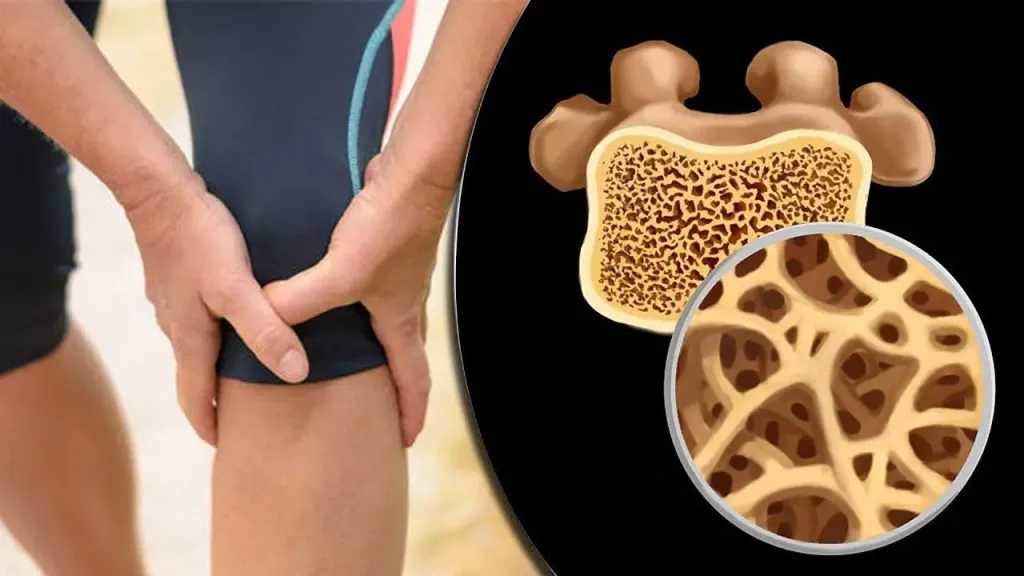 كل ما تود معرفته عن هشاشة العظام 