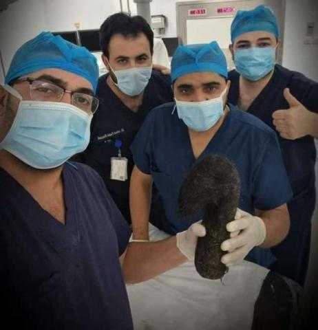 استخراج 6 كيلو «شعر» من بطن فتاة أُغلق جهازها الهضمي