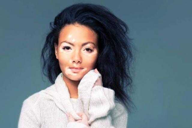 استشاري جلدية يكشف الفرق بين مرض البهاق والنخالة البيضاء