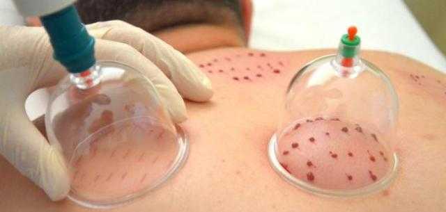 فتاوى الصيام.. ما حكم الحجامة ونقل الدم في نهار رمضان؟ «الإفتاء» تًجيب