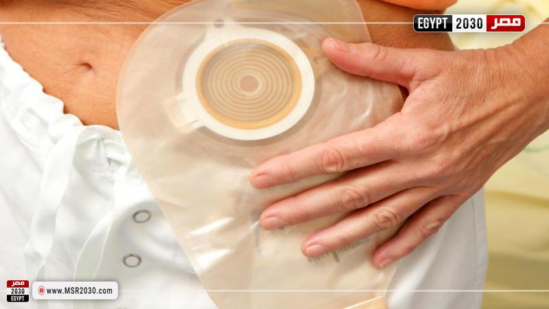 مريض يحمل نجاسته في كيس