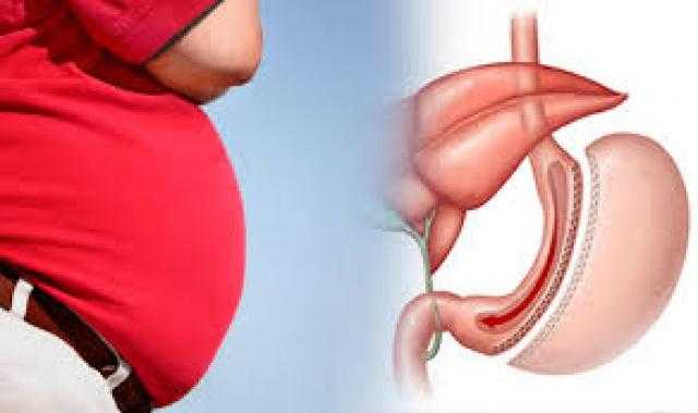 هؤلاء ممنوع عليهم «تكميم المعدة».. طبيب يشرح التفاصيل