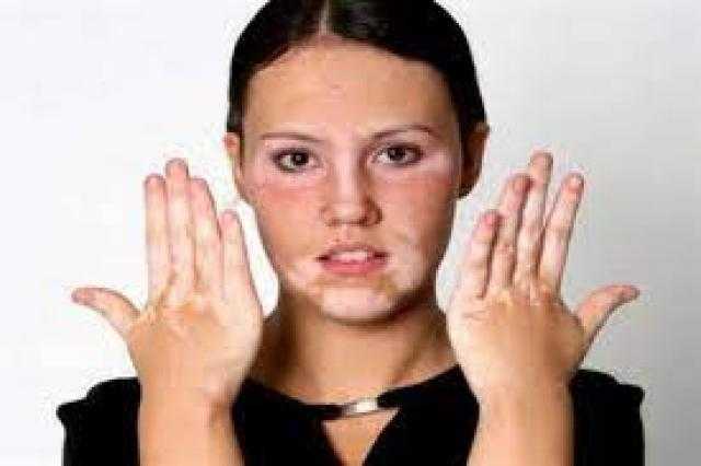 توصلنا للعلاج.. «الناظر» يزف بشرى سارة لمصابي البهاق