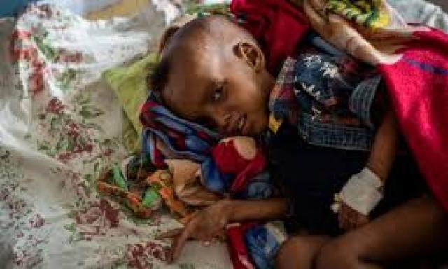 طفل من إقليم تيجراي يعاني الجوع والمرض 