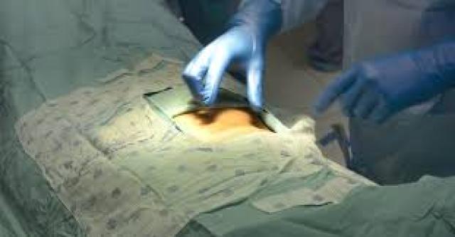 استئصال المرارة