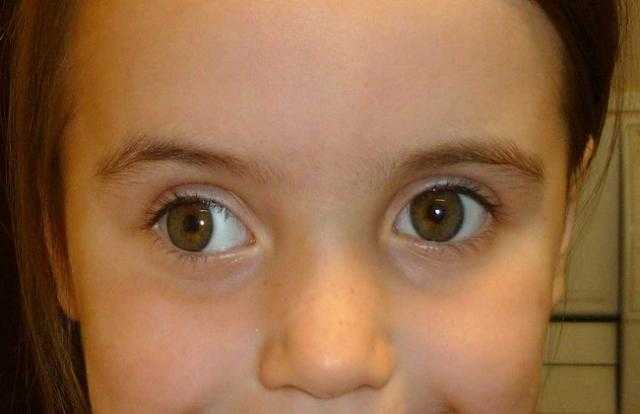 طبيب عيون يكشف خطورة عدم علاج الحول للأطفال (فيديو)