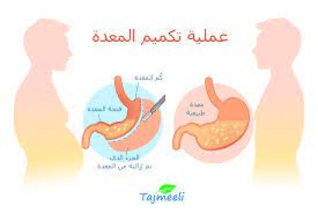 تميم المعدة 