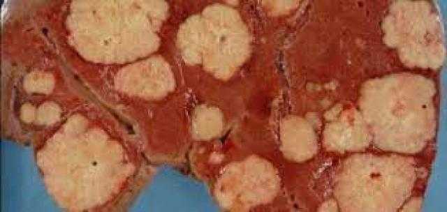 علاج جديد.. مبادرة للاكتشاف المبكر لسرطان الكبد.. تفاصيل