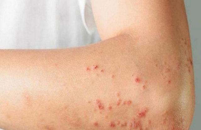 أستاذ أوبئة يكشف مفاجأة عن مصدر العدوى الأساسي بجدري القرود «فيديو»