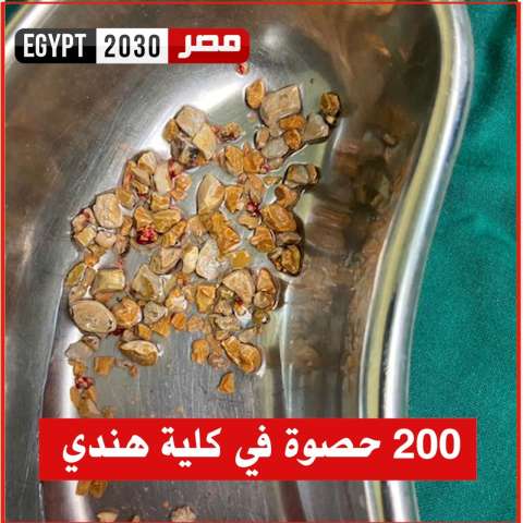 إزالة أكثر من 200 حصوة من كلية رجل هندي