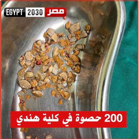 أطباء ينجحون في إزالة أكثر من 200 حصوة من كلية رجل هندي