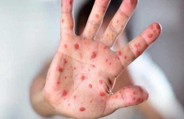 دولة أوروبية جديدة تعلن تسجيل أول إصابة بجدري القرود