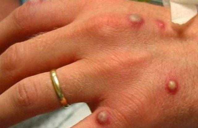 5 طرق لحمايتك من الإصابة بعدوى جدري القرود «فيديو»