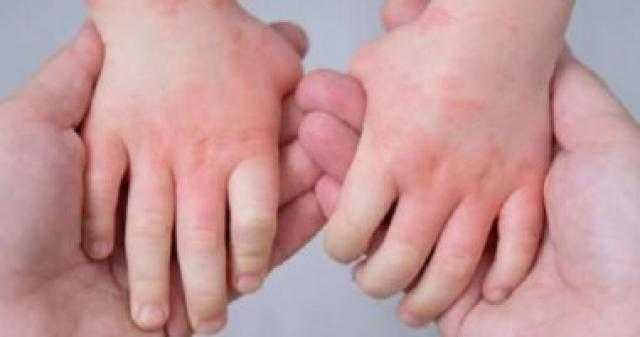 بعد انتشاره في الهند.. كيف تحمي طفلك من فيروس «حمي الطماطم»؟ - فيديو