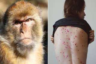 فيروس يهدد العالم.. تسجيل أول حالة إصابة مؤكدة بجدري القرود في أيرلندا