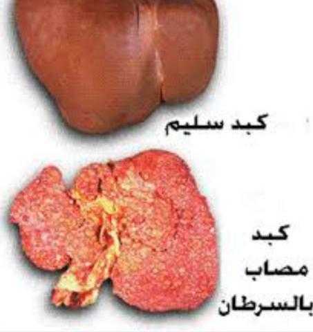 مبادرة رئاسية لإنقاذ مرضى أورام الكبد