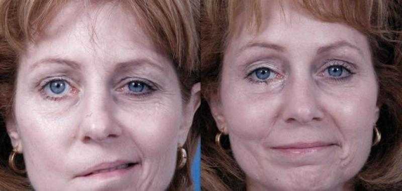 هل يسبب لقاح كوورنا الإصابة بالشلل النصفي؟.. رد صادم