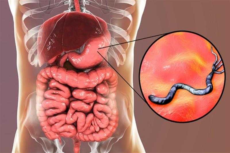 ما هي أعراض و أسباب الإصابة بجرثومة المعدة؟