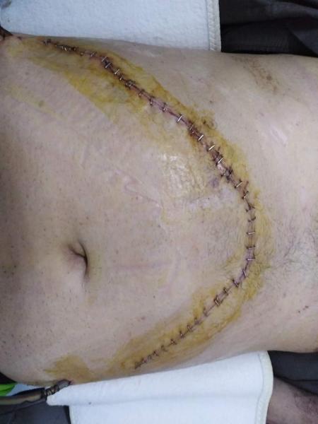 100 غرزة في بطن المريض