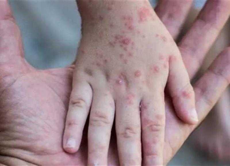 حقيقة ظهور جُدري القرود في مصر «فيديو»