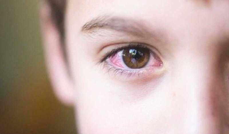 هذا ما يجب عليك فعله حال إصابة طفلك بالرمد الربيعي