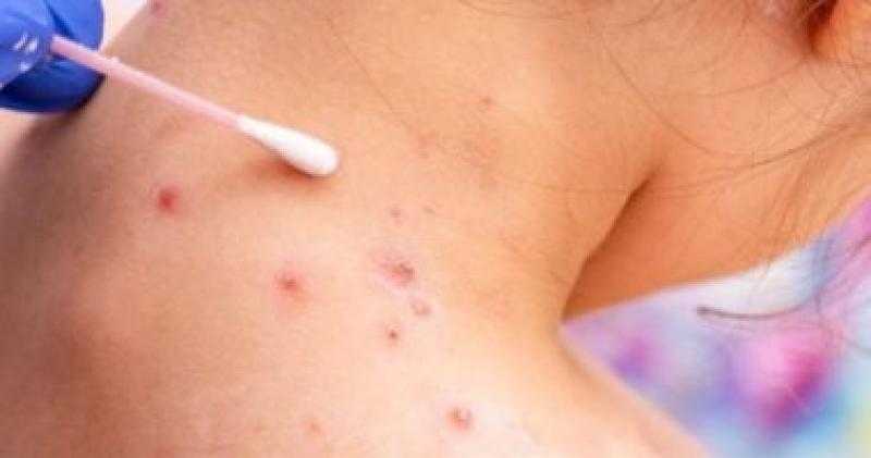 رعب شديد .. أمريكا تعلن ارتفاع إصابات جدري القرود لـ 142 حالة