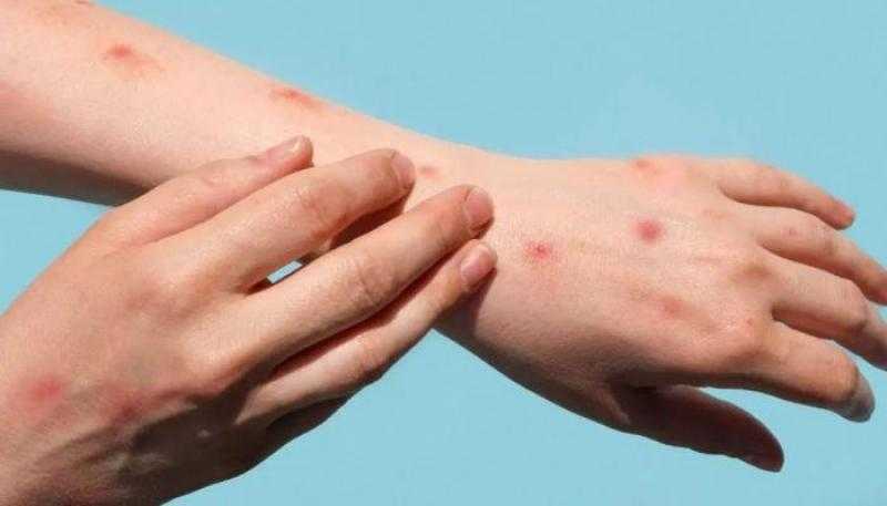 «تورم الغدد الليمفاوية».. «الناظر» يكشف أعراض خطيرة لـ جدري القرود - فيديو