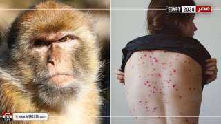 الصحة العالمية تحذر: ارتفاع إصابات جدري القرود ثلاثة أضعاف في أوروبا