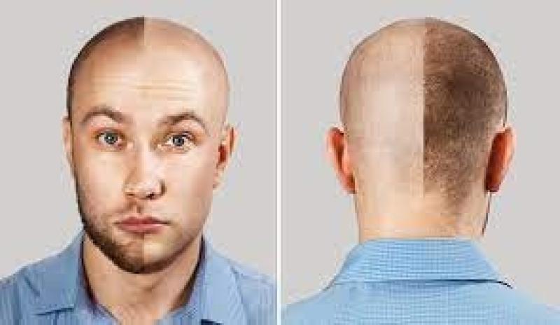 هل زراعة الشعر حرام؟ الإفتاء توضح الحكم