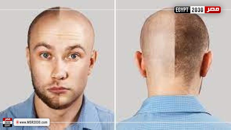 زراعة الشعر