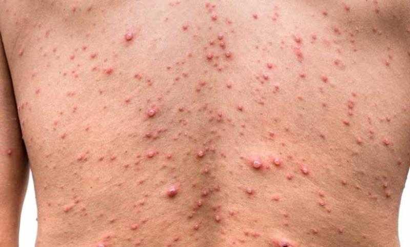 «رفع درجة التأهب».. تحذير عاجل من خطورة جدري القردة - فيديو