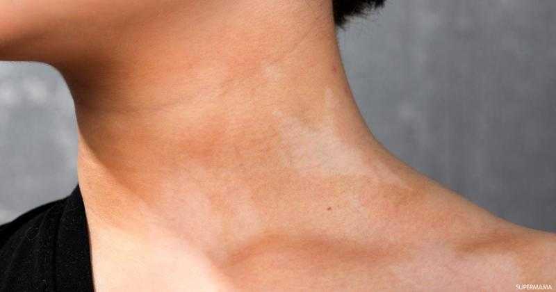 ما الفرق بين النخالة البيضاء والبهاق؟.. هاني الناظر يوضح - «فيديو»