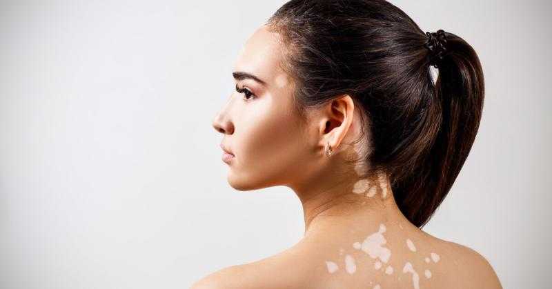 مفاجأة غير متوقعة بشأن سعر العلاج الجديد لمرض البهاق.. «فيديو»