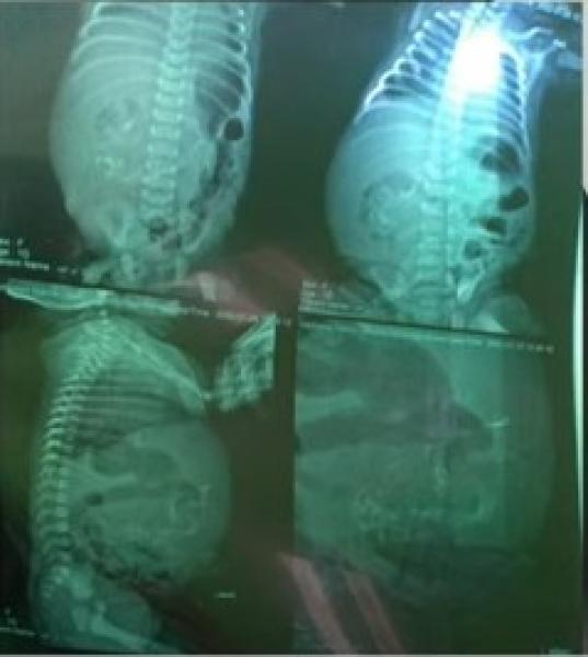 شاهد .. طفلة حديثة الولادة تحمل جنينا في أحشائها وطبيبها يفجر مفاجأة