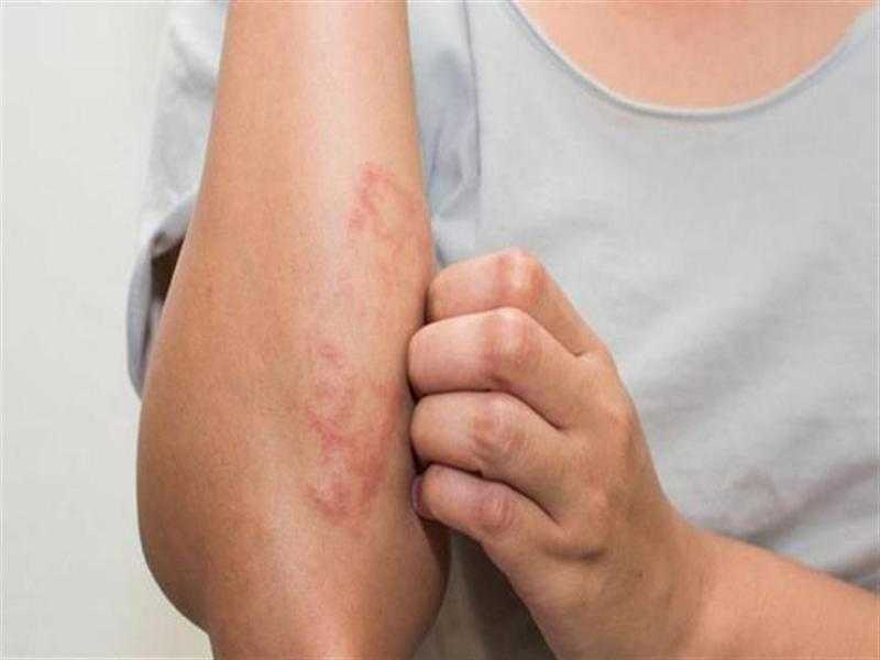 بـ 8 جرعات إشعاعي.. عالم مصري يكتشف طريقة جديدة لعلاج سرطان الجلد - فيديو