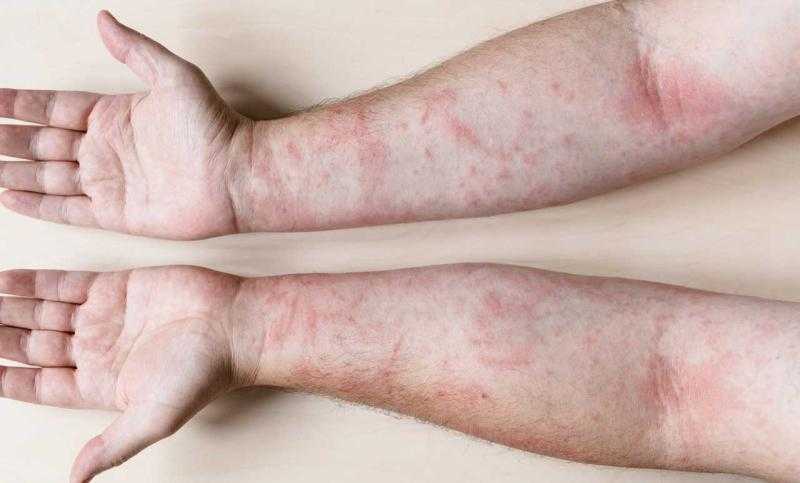 استشاري تكشف مخاطر مرض الصدفية المفصلية وكيف يمكن تشخيصها