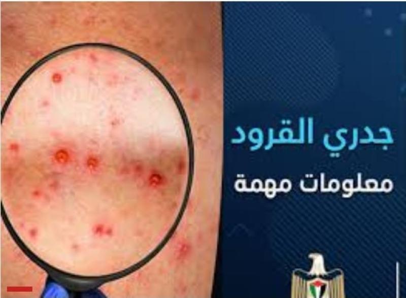 جدري القرود 