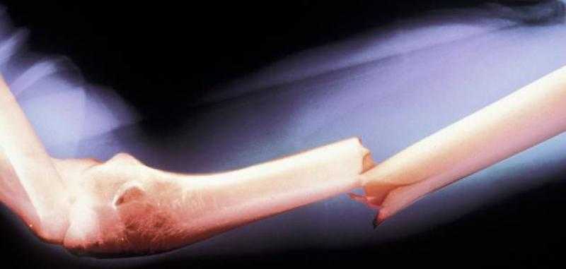 أكثر عرضة للكسور.. أضرار صحية للأشخاص النباتيون «فيديو»