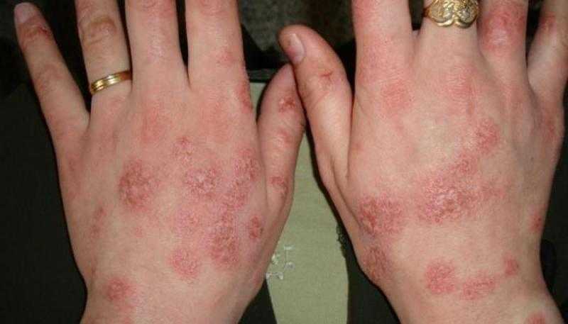 كيف تتخلصي من «إكزيما ست البيت»؟ - فيديو