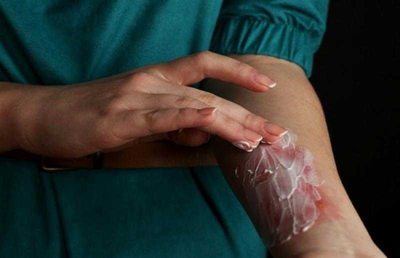 هاني الناظر يحذر: علاج الحروق بالثلج والمعجون خرافات «فيديو»