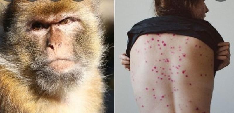 بعد ظهوره في مصر.. المصل واللقاح تحذر هذه الفئة من جدري القرود «فيديو»