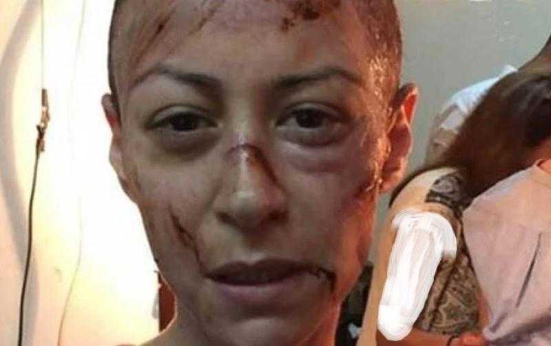 شاهد.. إصابة بالغة لمنة شلبي في وجهها تُثير الجدل