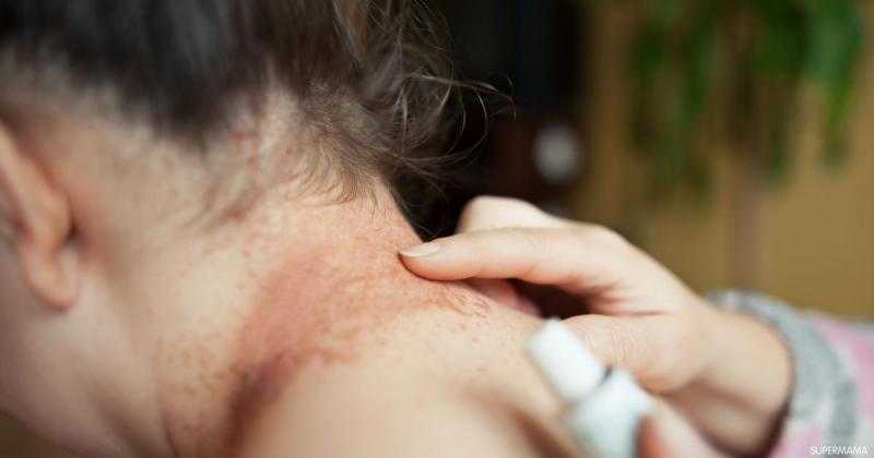 ما هي التينيا وهل تشكل خطورة على الحوامل؟.. هاني الناظر يُجيب