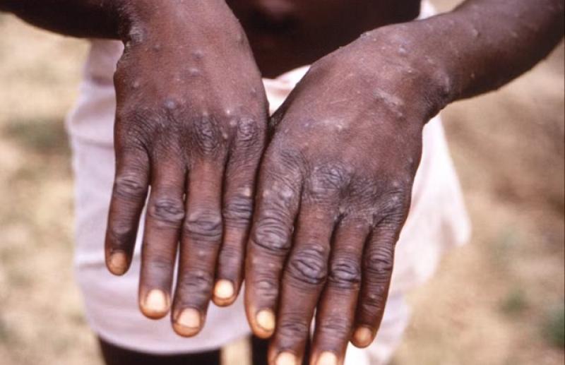 الصحة تعلن تفاصيل تسجيل ثاني حالات الإصابة بجدري القرود.. «فيديو»