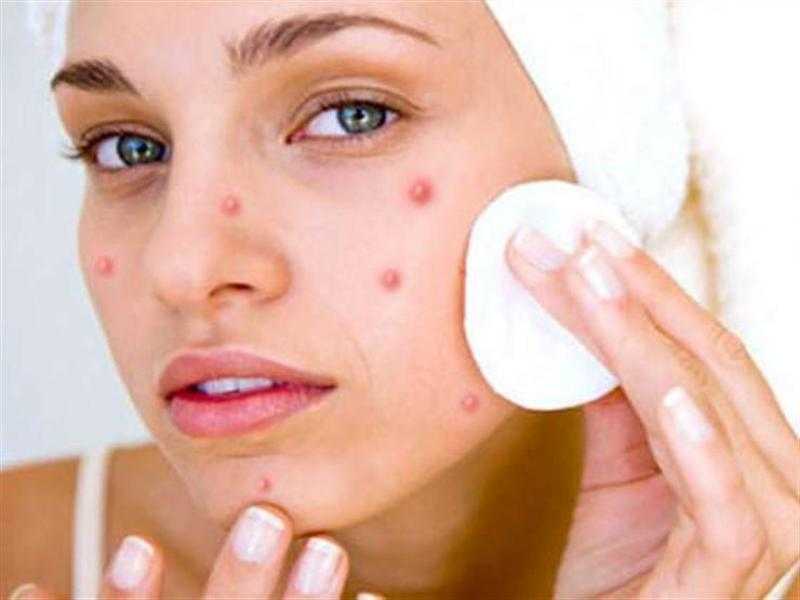طرق طبيعية فعالة لعلاج حب الشباب بمكونات متوفرة في المنزل