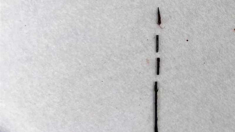 استخراج ”إبرة تنجيد” من جسد مريض بـ”بنها الجامعي” بعد عامين