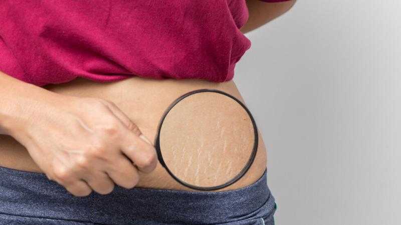 «وداعًا لعلامات التمدد».. 5 وصفات طبيعية لنتيجة فعالة