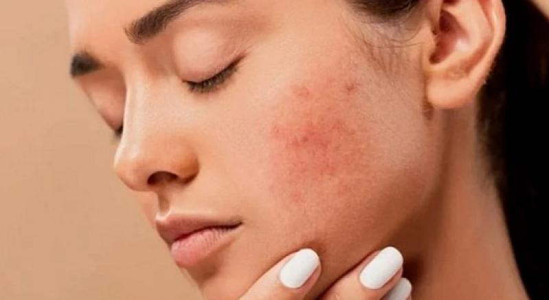 وصفات طبيعية للتخلص من ندبات البشرة