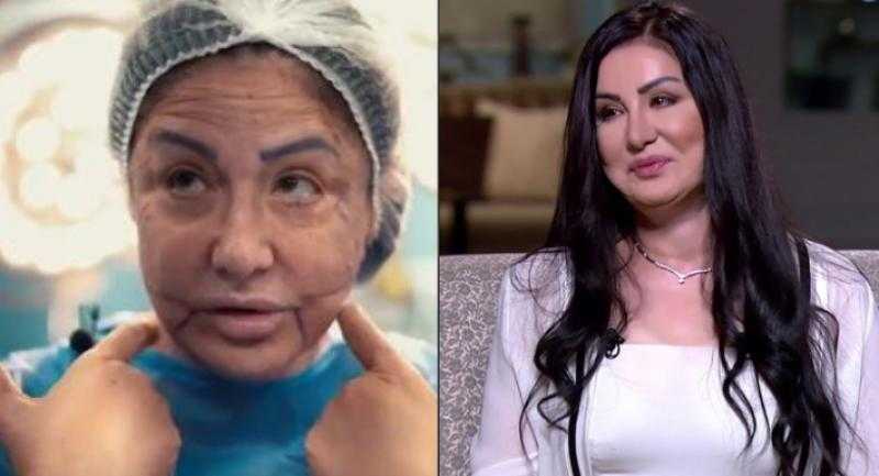 وفاء سالم: تعرضت للابتزاز من أطباء تجميل شوهوا وجهي