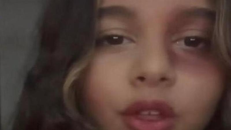 ابنة شيرين عبدالوهاب تظهر بعين متورمة وتكشف حقيقة الاعتداء عليها